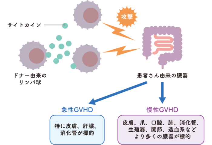 移植片対宿主病（GVHD）について