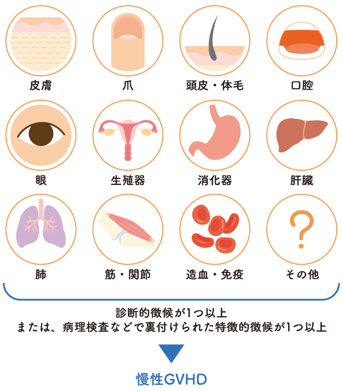 慢性GVHDの診断基準