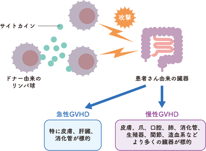 移植片対宿主病（GVHD）