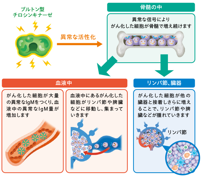 イムブルビカ®投与前のWM/LPL