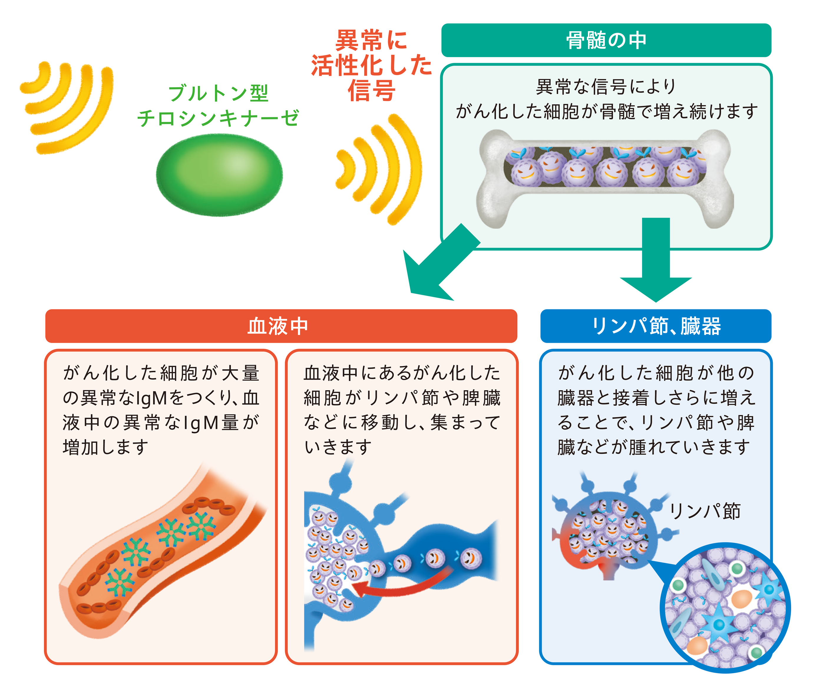イムブルビカ®投与前のWM/LPL
